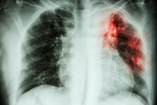 결핵 (Tuberculosis)의 원인과 치료