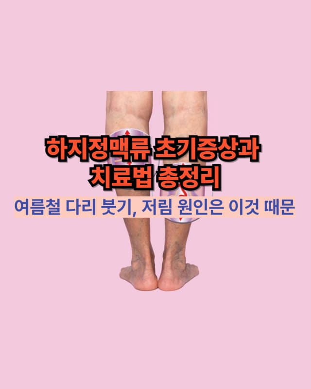 하지정맥류 썸네일 – 다리 정맥류 시각화 일러스트