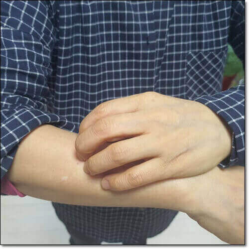 한랭 두드러기 치료