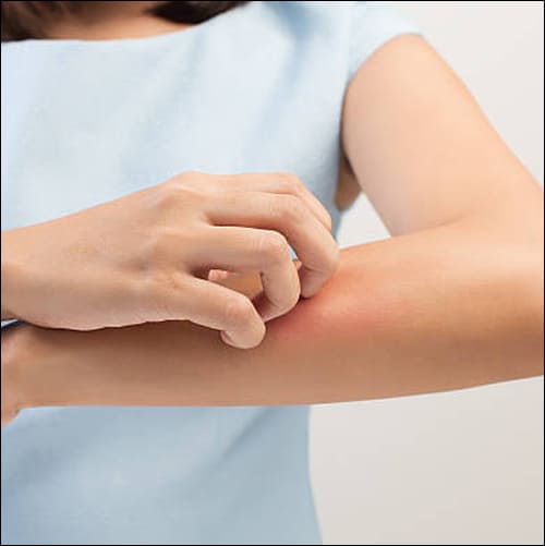 팔을 긁고 있는 여성