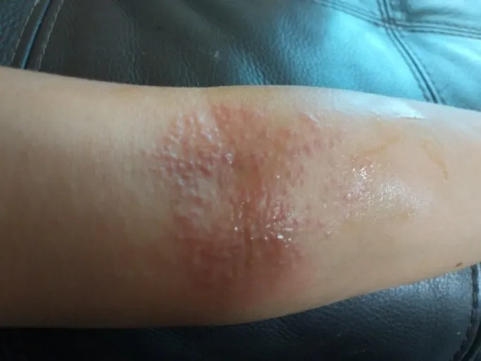 팔의-접히는-부분에-생긴-습진