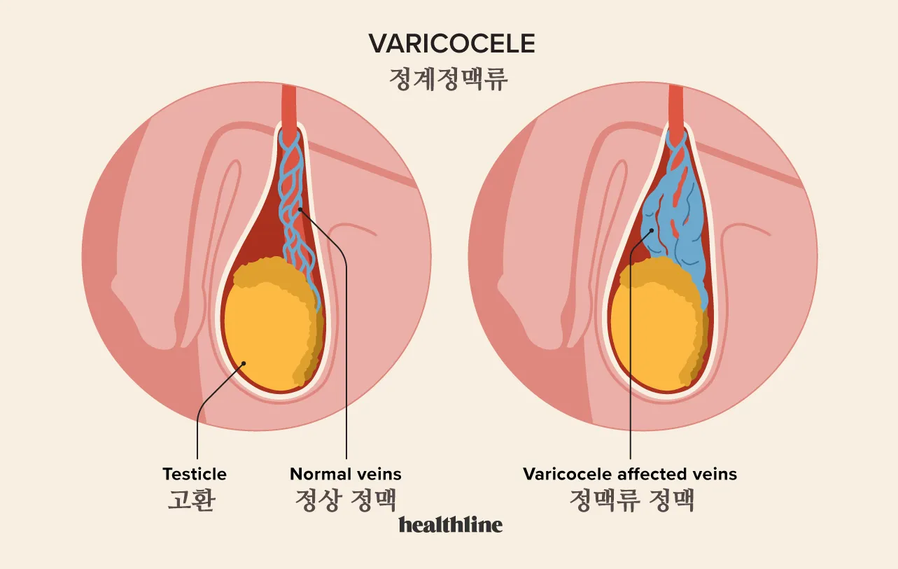 고환-혈관-정맥-정계정맥류