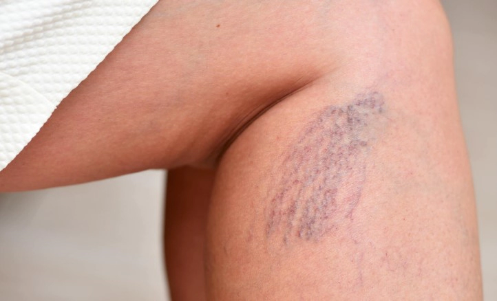 하지정맥류 초기증상