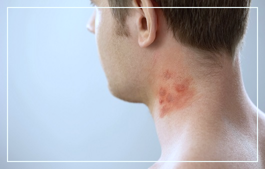 몸에-빨간점이-생기는-이유