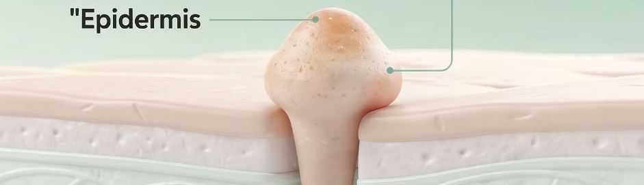 티눈 없애는 방법