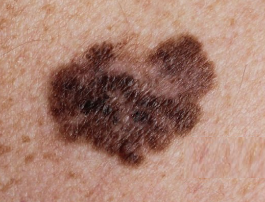 흑색종-피부의-악성-종양