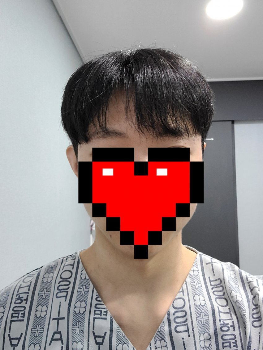 비절개모발이식후기