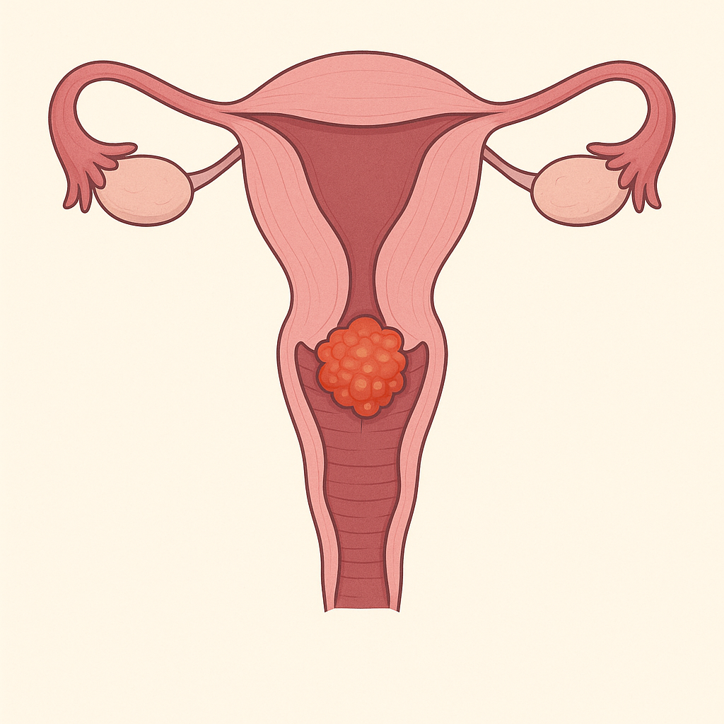 자궁경부암을 표시하는 자궁그림