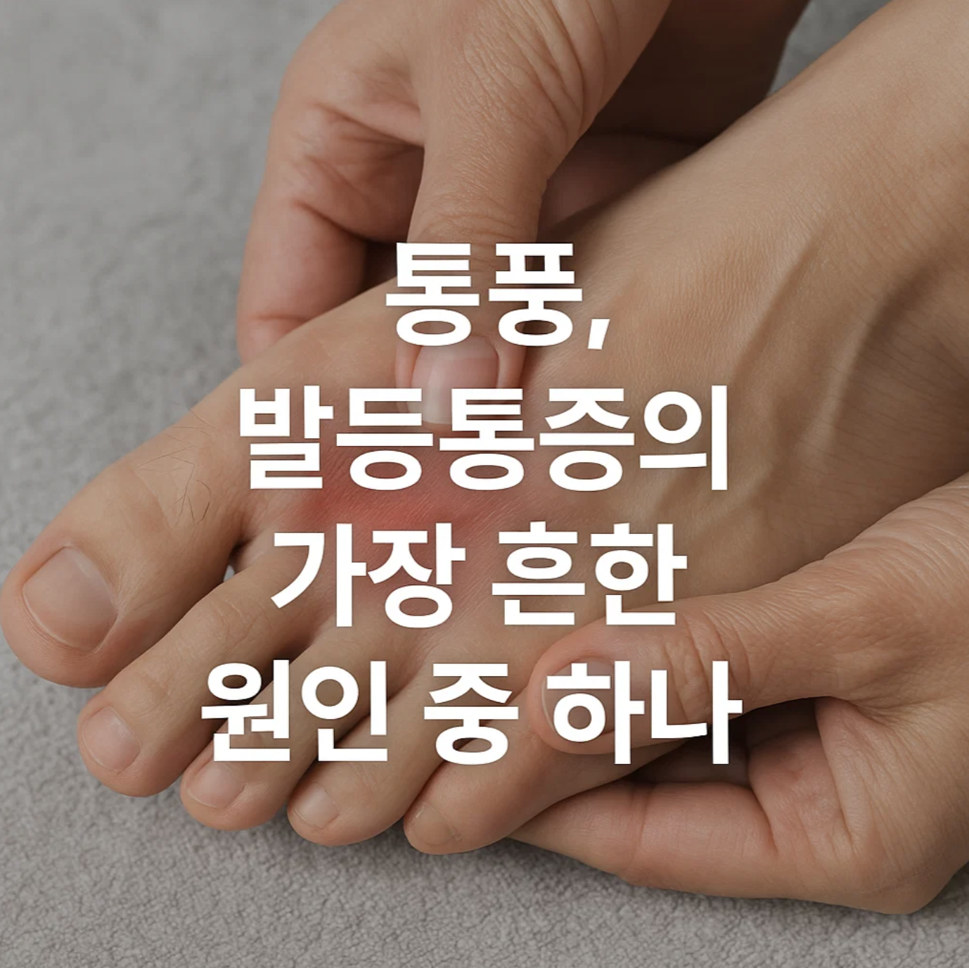 통풍, 발등통증의 가장 흔한 원인 중 하나