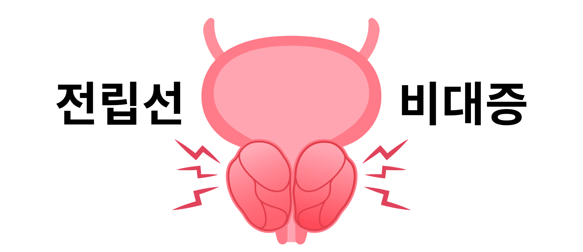 양성 전립선 비대증