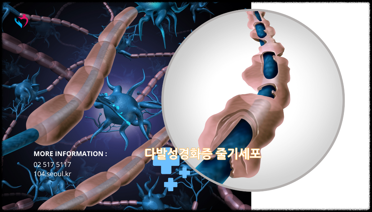 다발성경화증 줄기세포