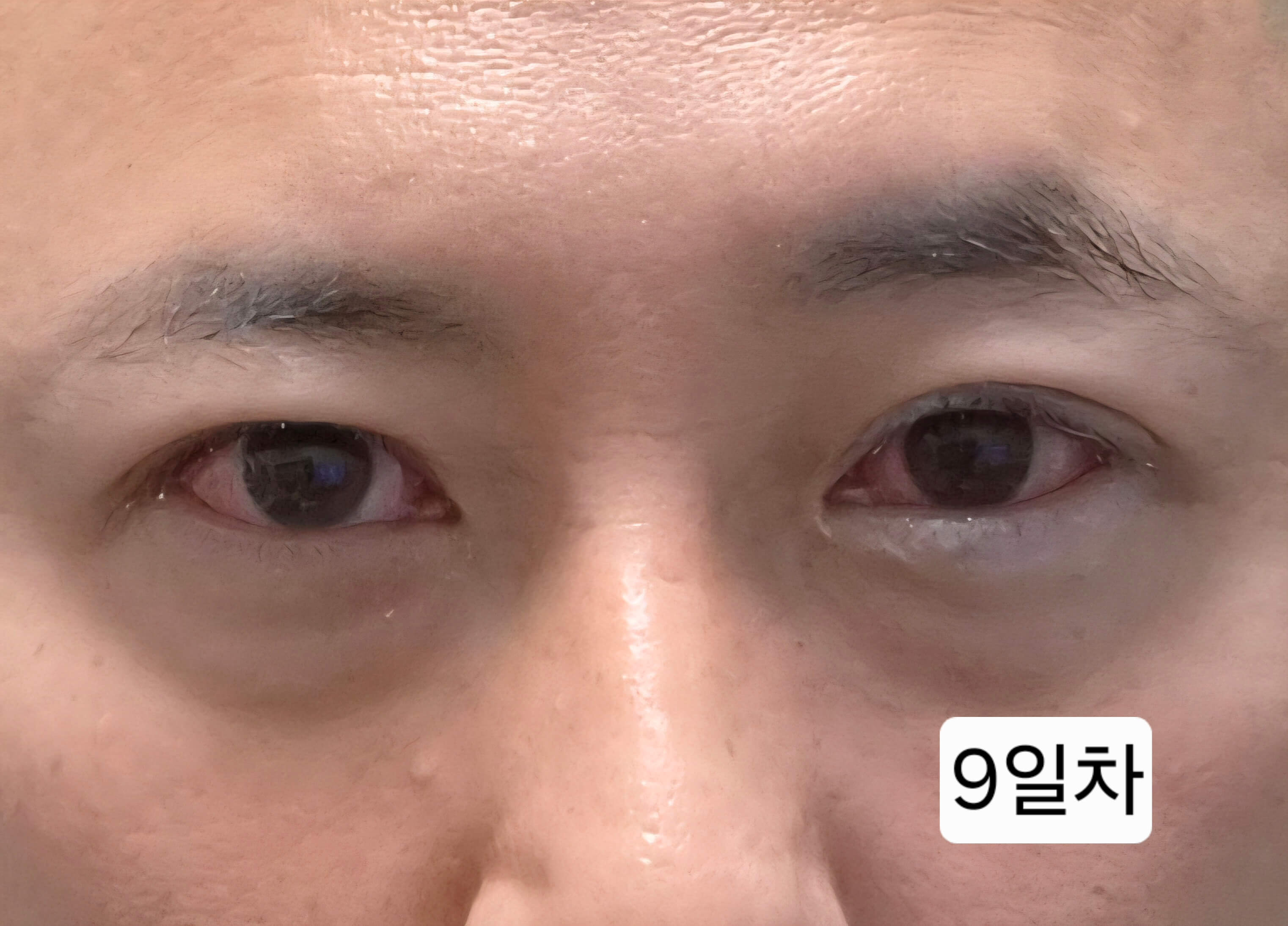 유행성각결막염 눈병 초기증상부터 12일차 치료 기록(진행 중)