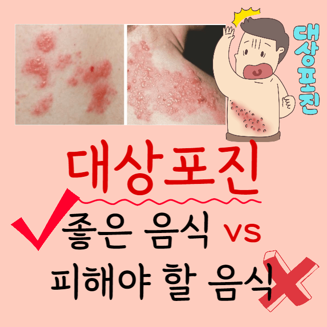 대상포진-좋은-음식-피할-음식-포스터