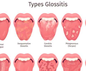 혓바늘이 돋는 이유 알아보기