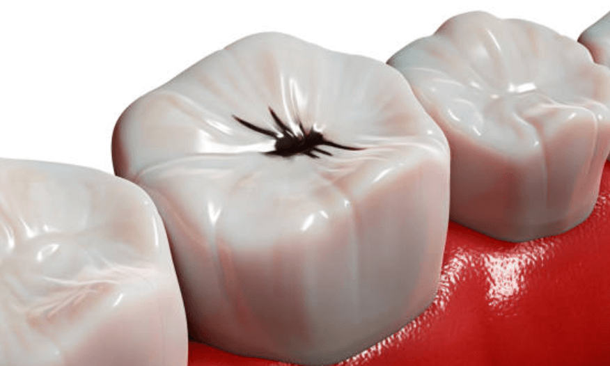 충치 치료 실비