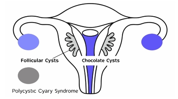 난소낭종 원인과 의심증상