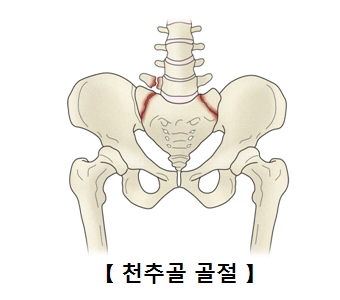 천추골 골절 출처 서울 아산 병원 홈페이지