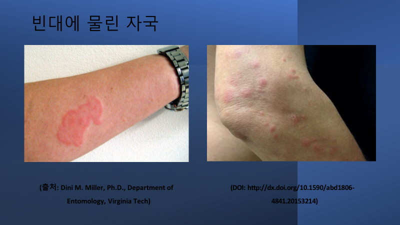 빈대에 물린 자국