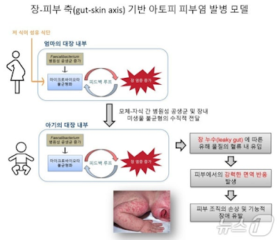엄마 장내 세균과 식이섬유 부족의 아토피 피부염 원인 관련 이미지