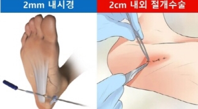족저근막염 이미지