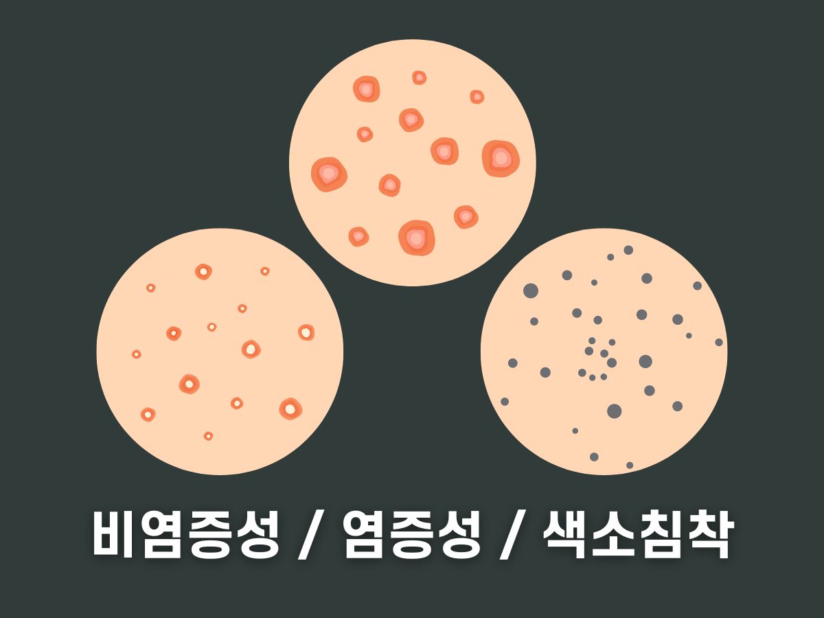 여드름 유형