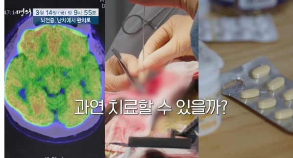 뇌전증-치료예후-이상건교수