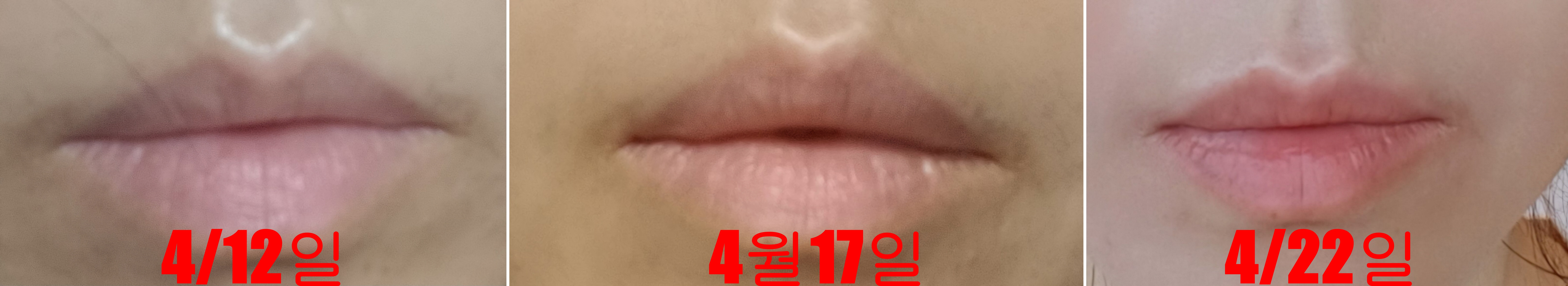 사람-입술-4월12일-4월17일-4월22일-변화-모습-4월22일에는-입술옆에-뭔가-갈색-선이-있는데-점점-흐려져-없어짐