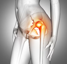 고관절 통증 증상 13