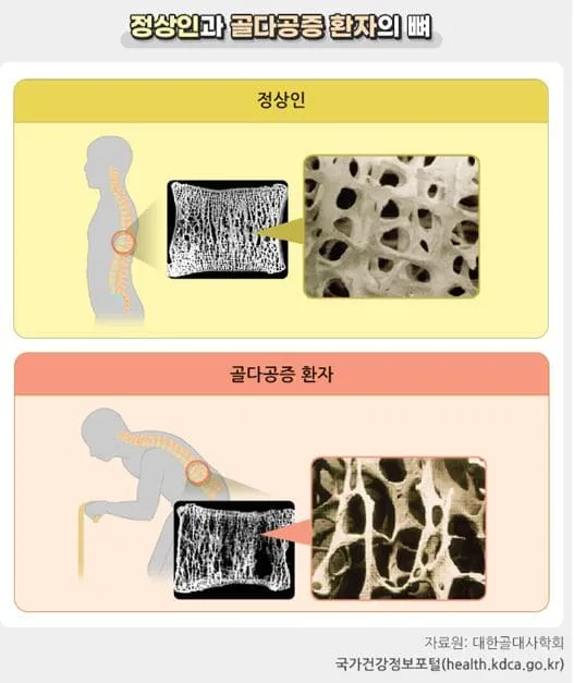 정상인과 골다공증 환자의 골밀도 차이