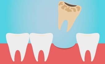 하얗고-건강한-치아-사이에서-누렇게-썩은이를-발치하는-모습