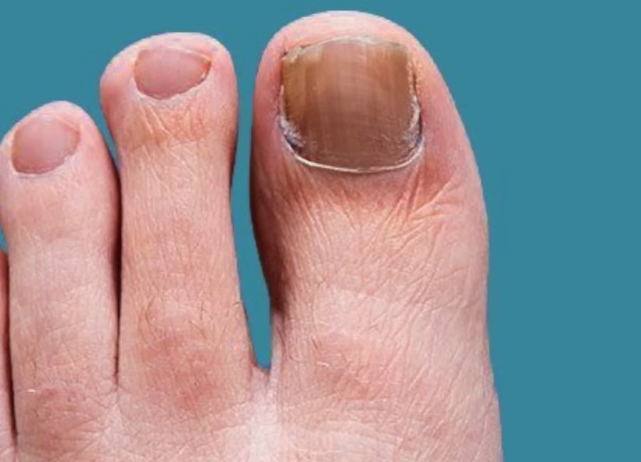 발톱이 검게 변하는 이유