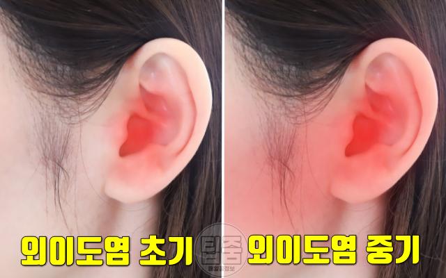 귀에서 물나옴 외이도염 증상 붉은기