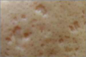 여드름 흉터 없애는법