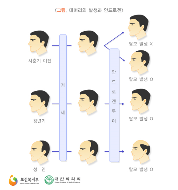 남성형탈모증