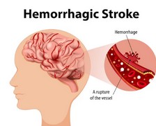 뇌출혈성 뇌졸중