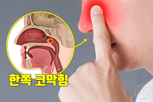 비인두암 증상 코막힘 비염 증상