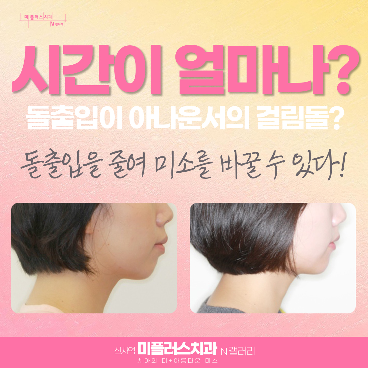 실제 아나운서 준비를 한 한 여성이 설측교정을 통해 돌출입을 개선한 사례