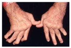 류마티스 관절염 초기증상