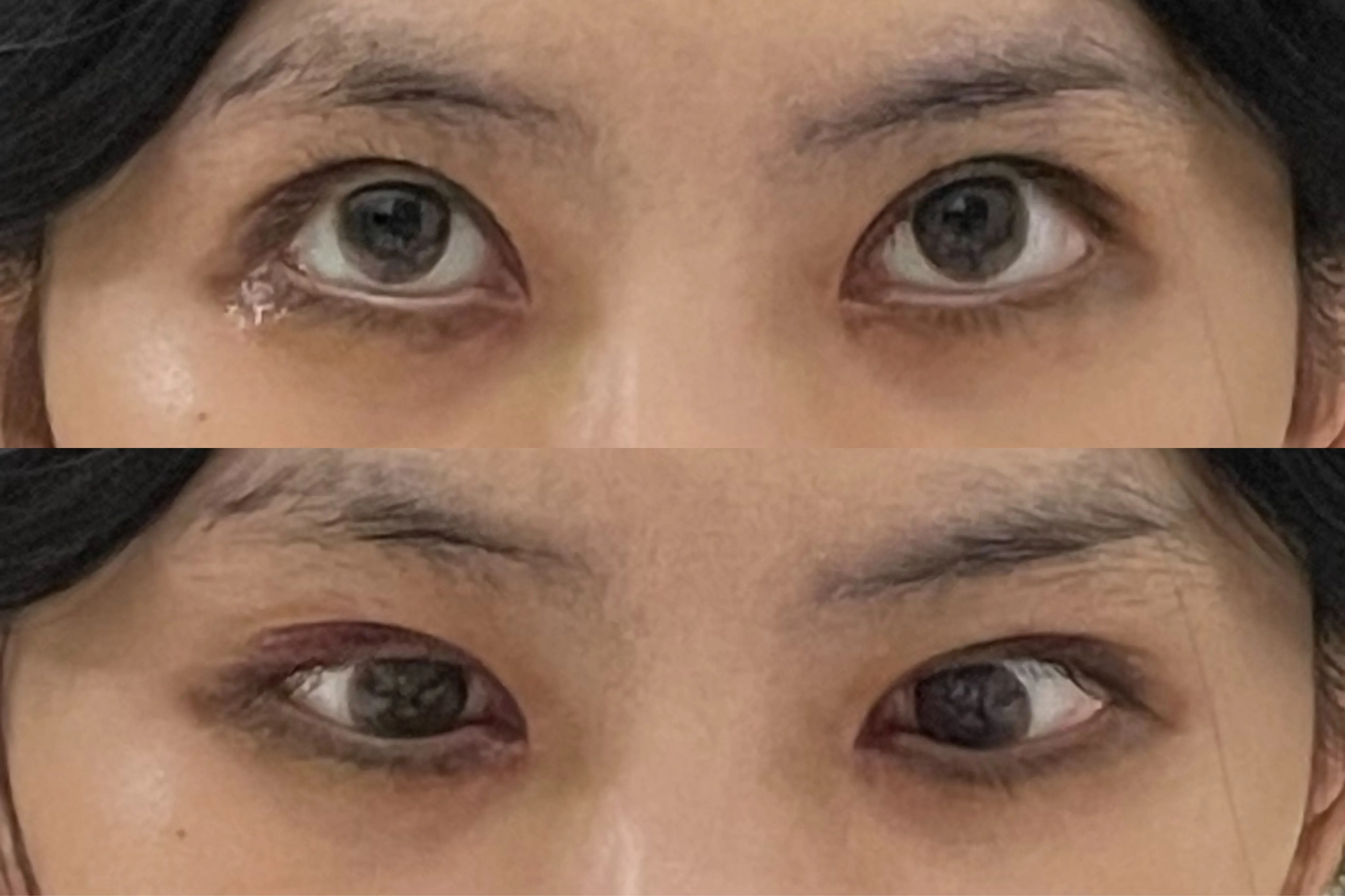 눈물샘 뚫는 수술 간단한가요에 대한 수술정보_2