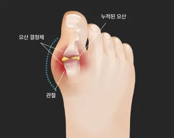 발가락 통풍 증상 및 대처방법_2