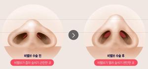 비염 수술