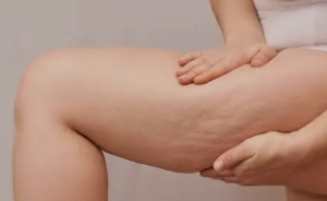 Attention, Cellulite Warriors: Effective Ways to Eliminate Cellulite.