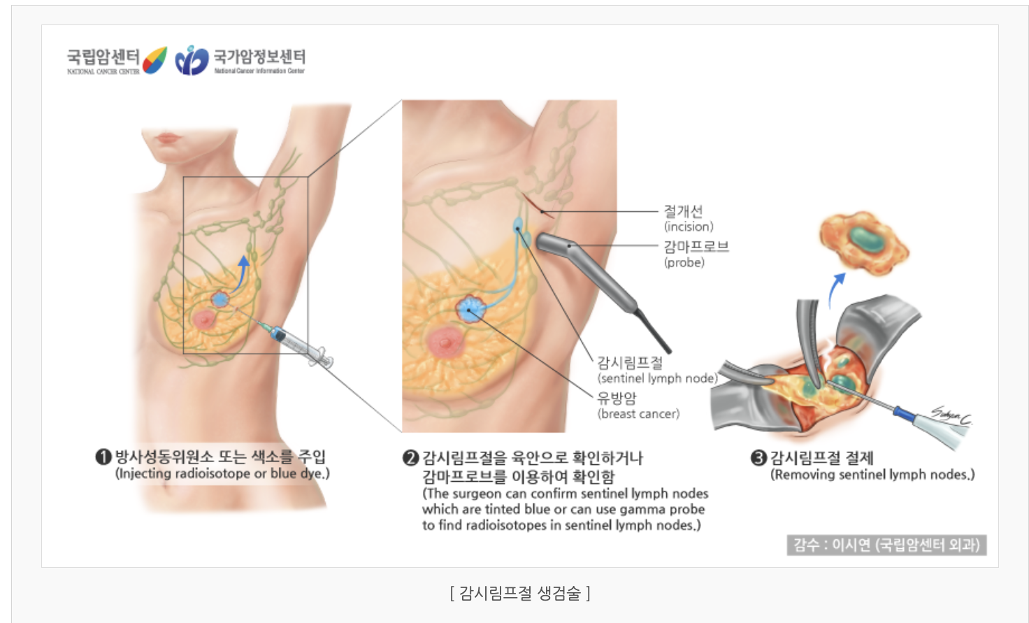 감시림프절 생검술