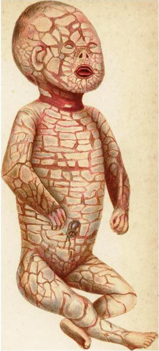 할리퀸 어린선을 가진 태아