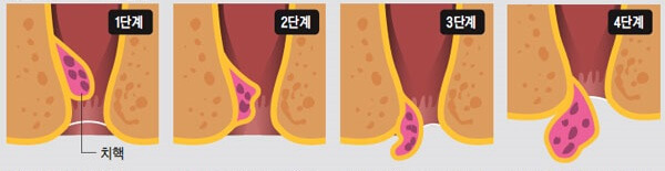치질 단계 1단계 2단계 3단계 4단계