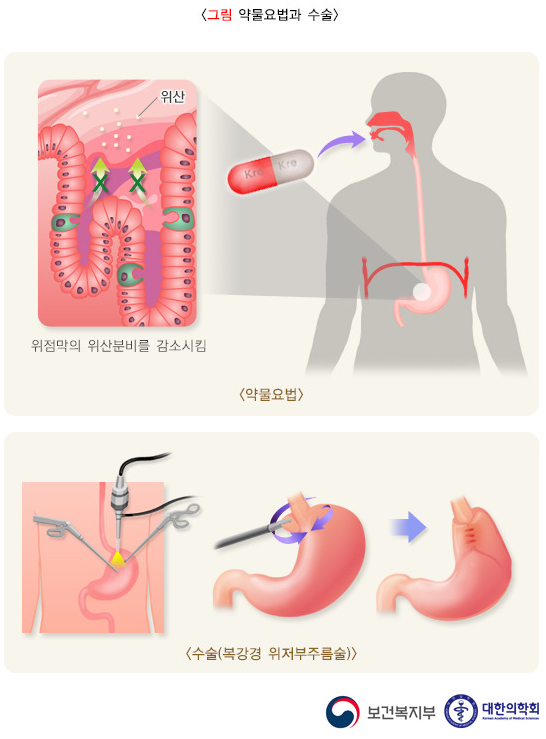 위식도 역류 질환의 원인과 증상, 진단, 치료와 예방 방법, 합병증