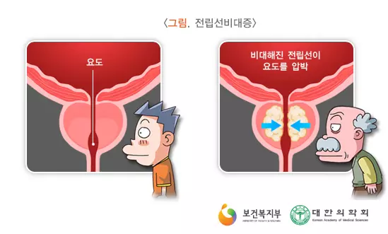 전립선비대증