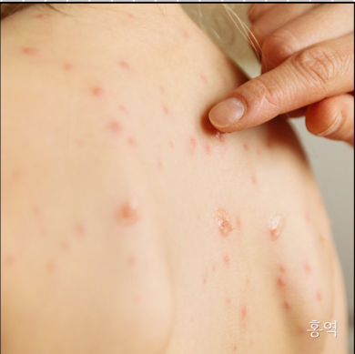홍역 증상 완벽 가이드