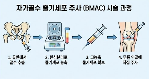 자가골수 줄기세포 시술 과정