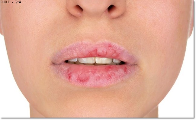 입술이 붓는 이유